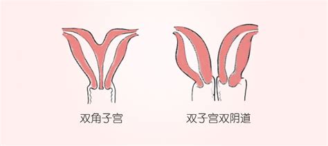双子宫的人能正常生育吗